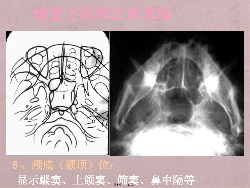 鼻窦影像诊断_第7页