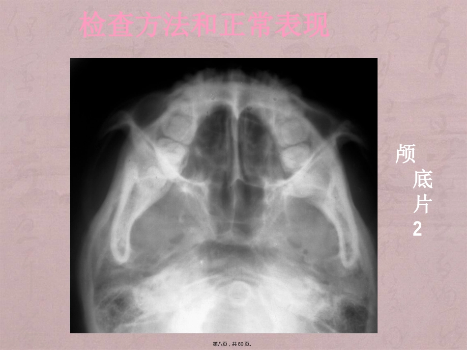 鼻窦影像诊断_第8页