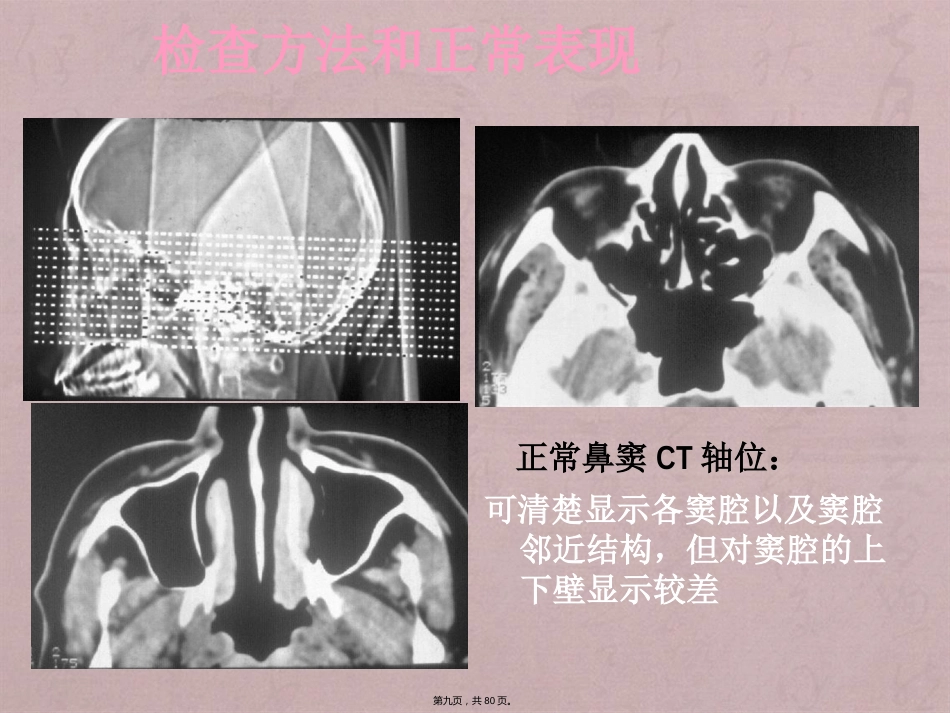 鼻窦影像诊断_第9页