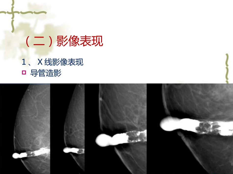 常见乳腺肿瘤的影像表现_第11页