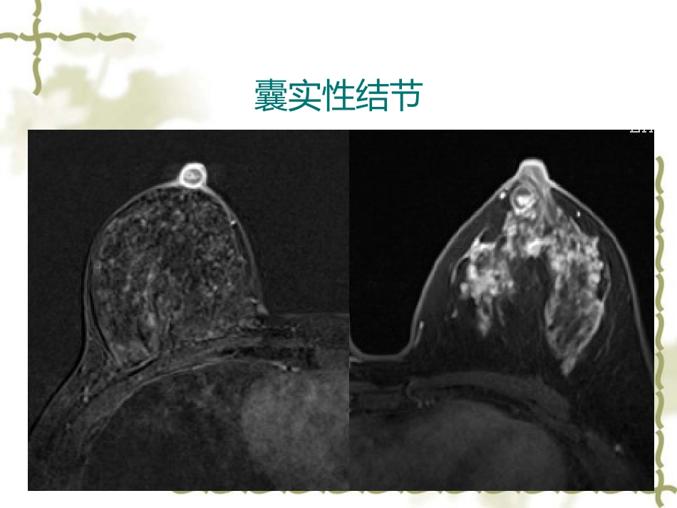 常见乳腺肿瘤的影像表现_第14页