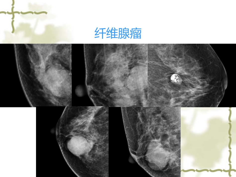 常见乳腺肿瘤的影像表现_第7页
