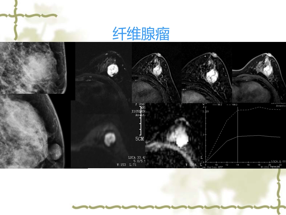 常见乳腺肿瘤的影像表现_第8页