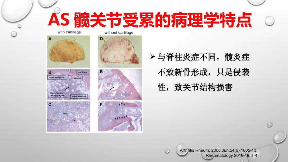 AS髋关节受累及影像学诊治进展PPT_第15页