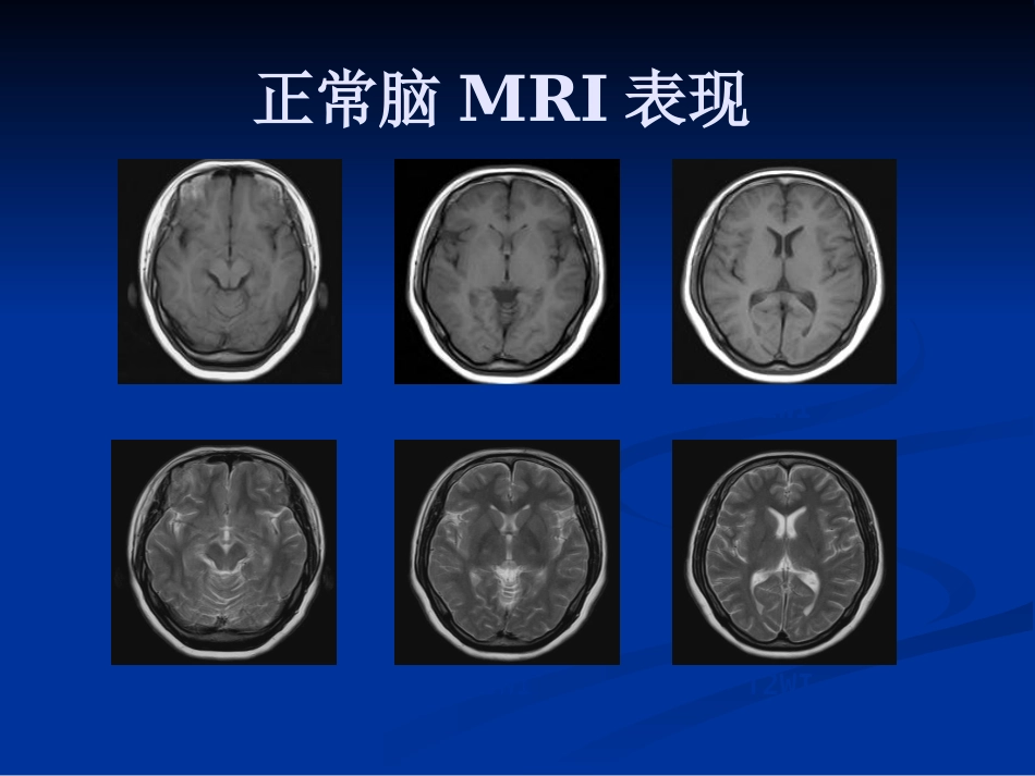 CTMRI颅脑影像看片PPT教案_第10页