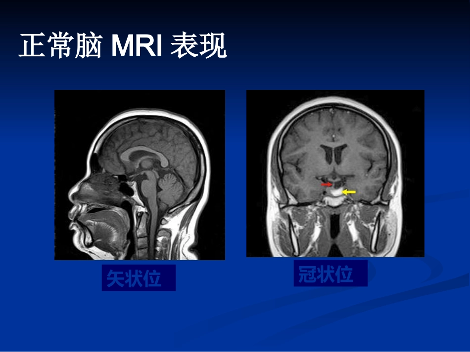 CTMRI颅脑影像看片PPT教案_第11页
