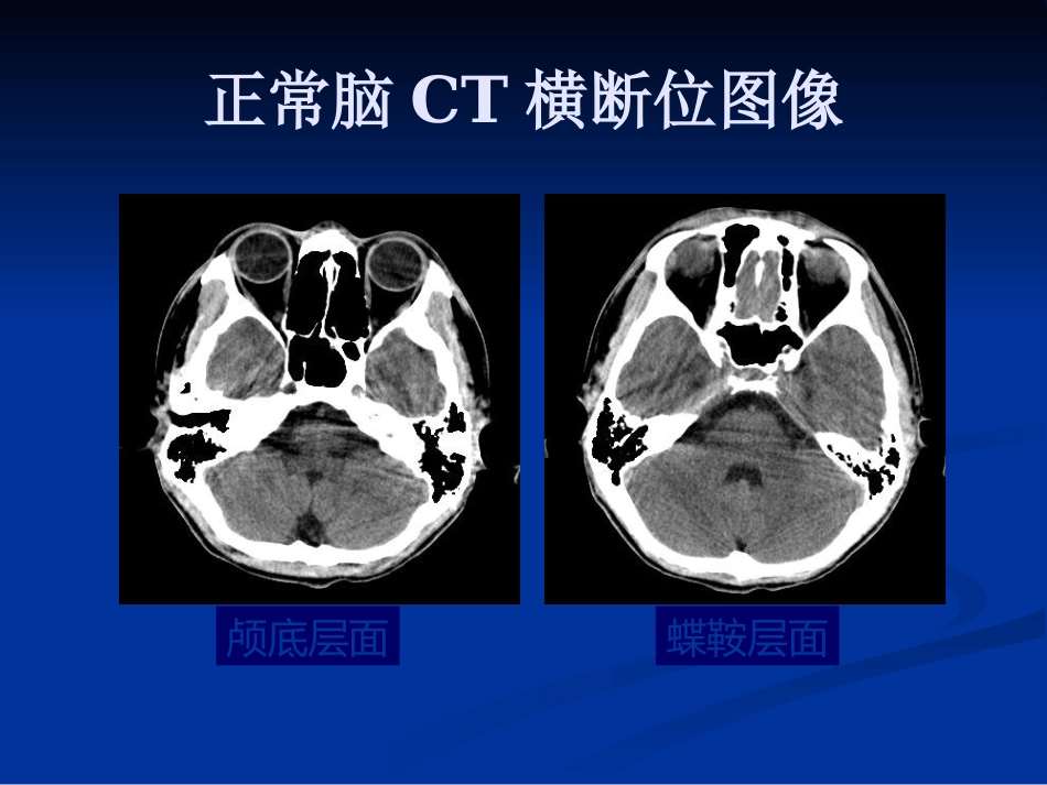 CTMRI颅脑影像看片PPT教案_第4页