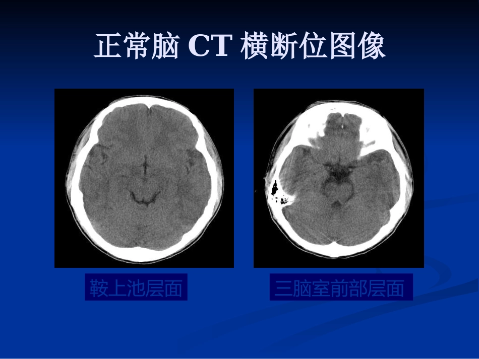 CTMRI颅脑影像看片PPT教案_第5页