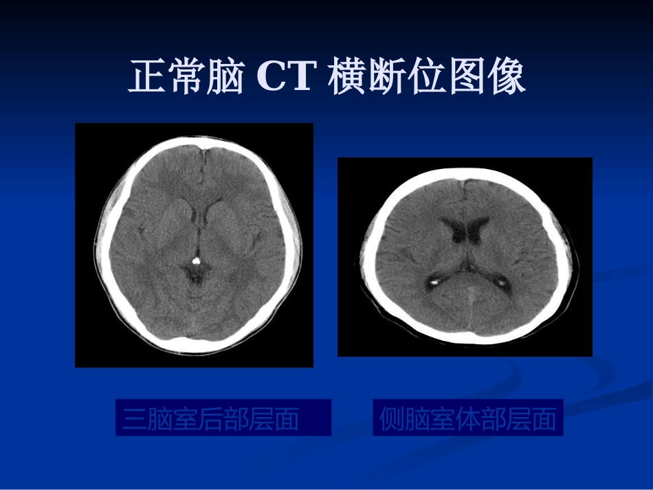 CTMRI颅脑影像看片PPT教案_第6页