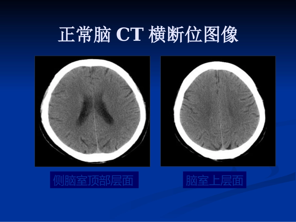 CTMRI颅脑影像看片PPT教案_第7页