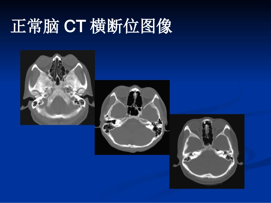CTMRI颅脑影像看片PPT教案_第8页