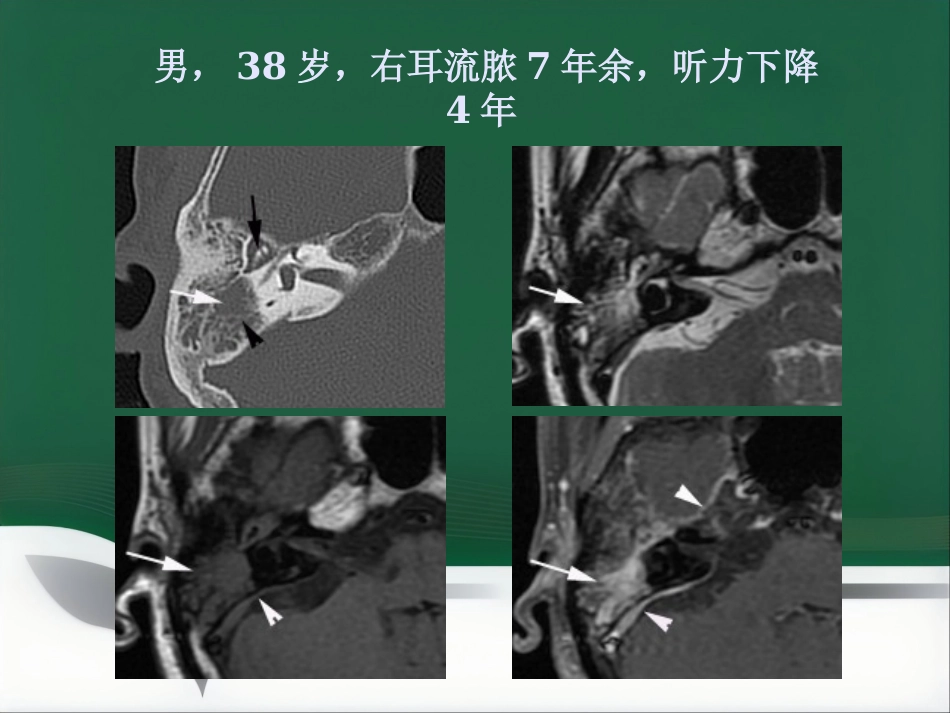 常见耳科症状影像学检查路径与分析思路_第10页