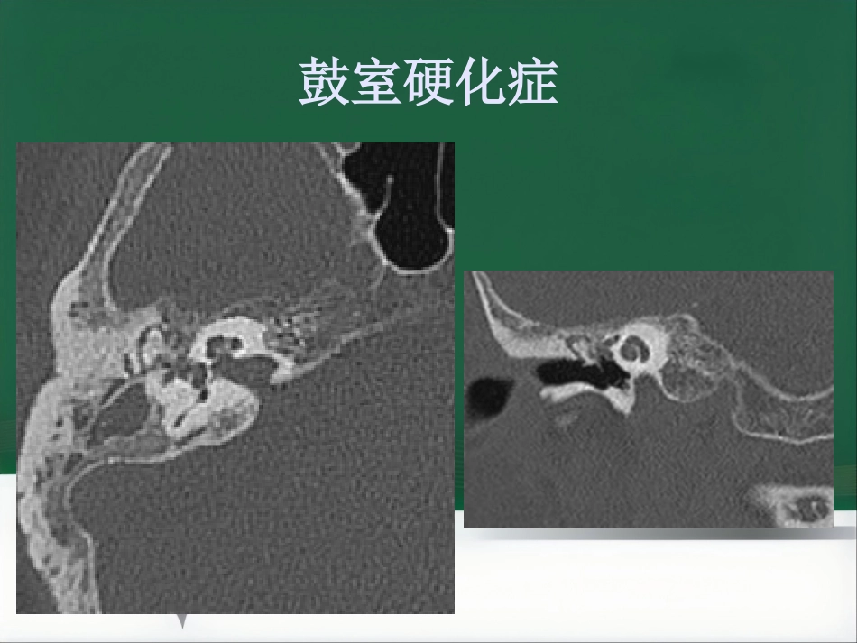 常见耳科症状影像学检查路径与分析思路_第11页