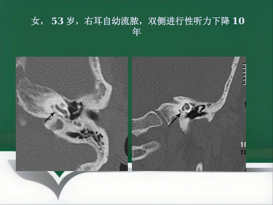 常见耳科症状影像学检查路径与分析思路_第13页