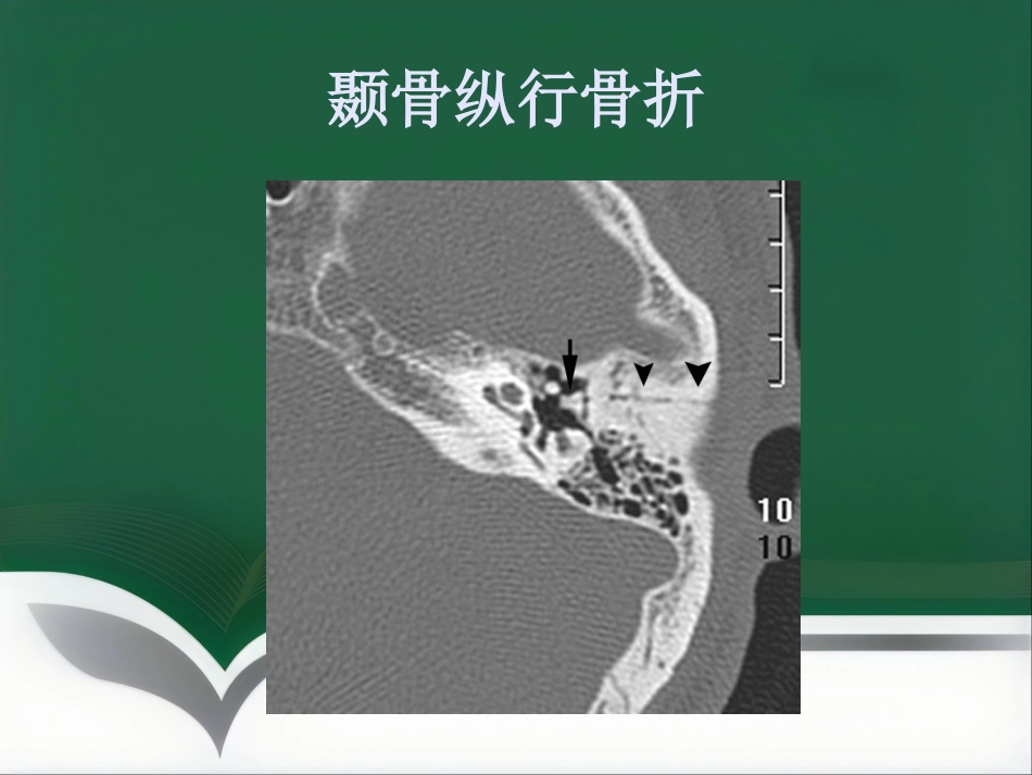 常见耳科症状影像学检查路径与分析思路_第14页