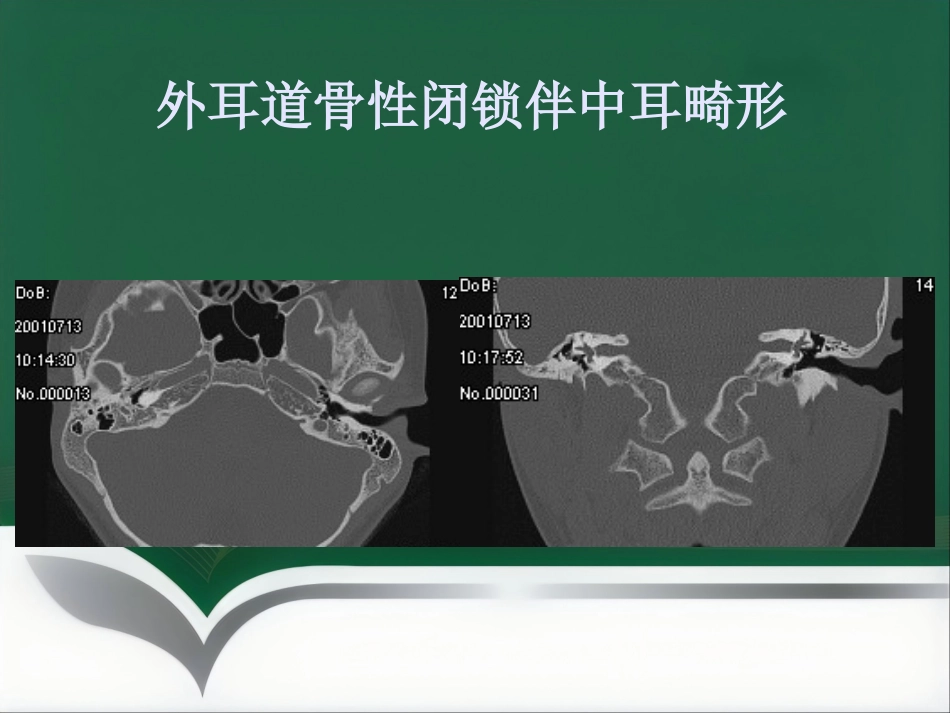 常见耳科症状影像学检查路径与分析思路_第5页