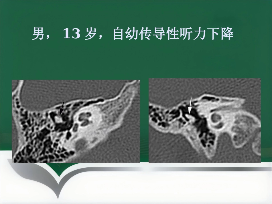 常见耳科症状影像学检查路径与分析思路_第6页