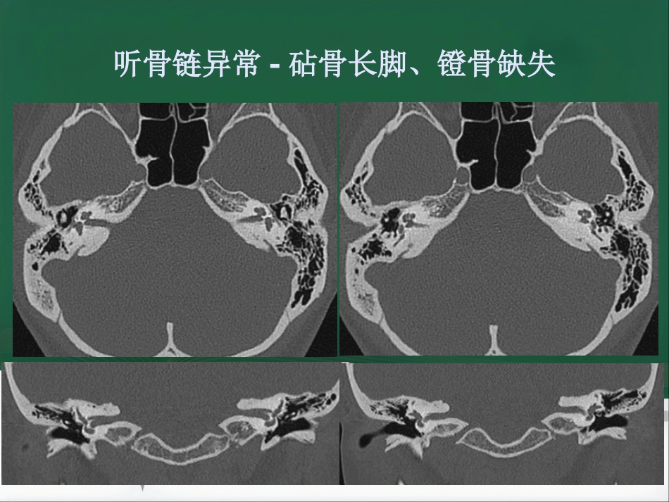 常见耳科症状影像学检查路径与分析思路_第7页