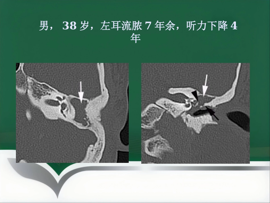 常见耳科症状影像学检查路径与分析思路_第8页