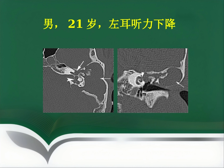 常见耳科症状影像学检查路径与分析思路_第9页