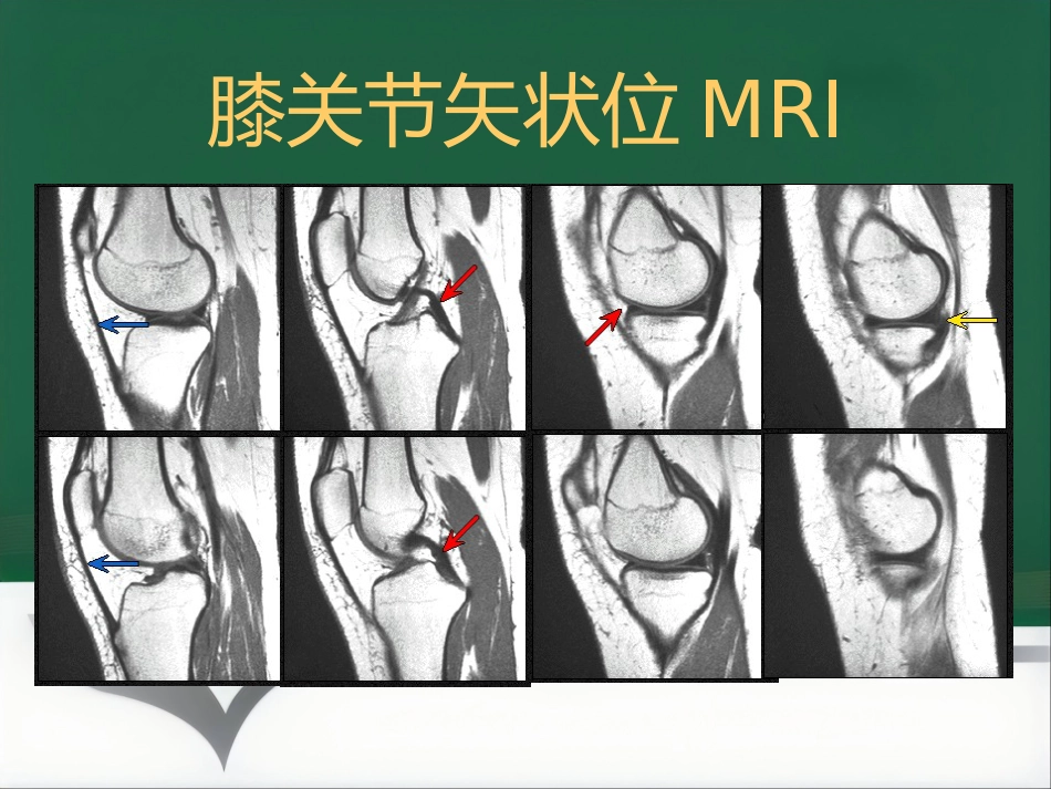 常见骨关节疾病MRI影像学表现_第14页