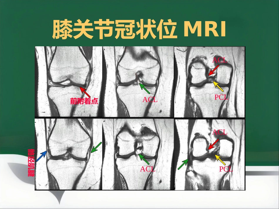 常见骨关节疾病MRI影像学表现_第15页
