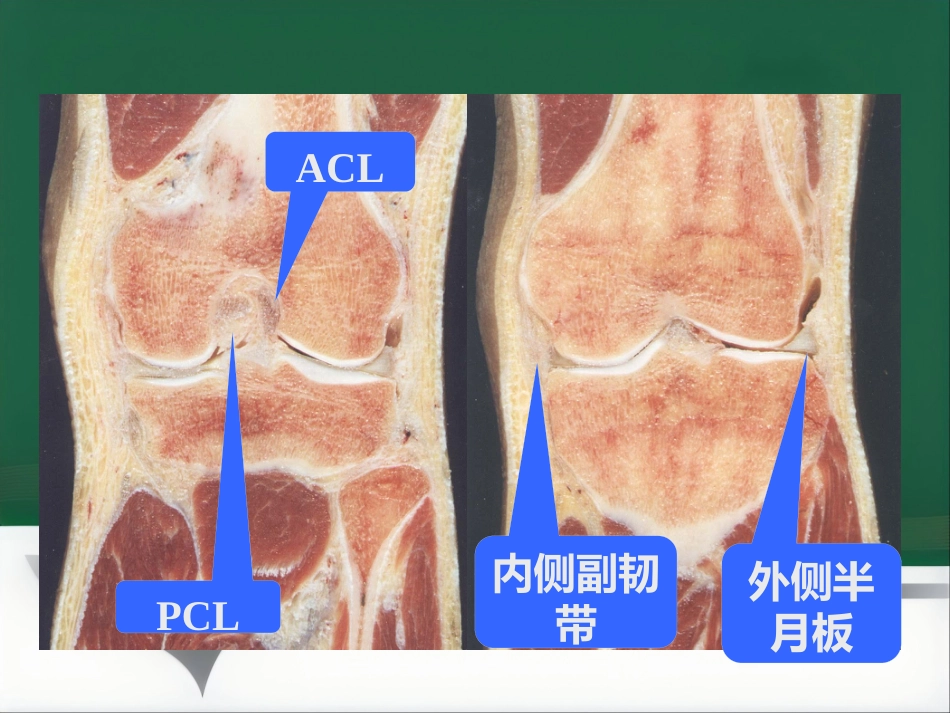 常见骨关节疾病MRI影像学表现_第6页