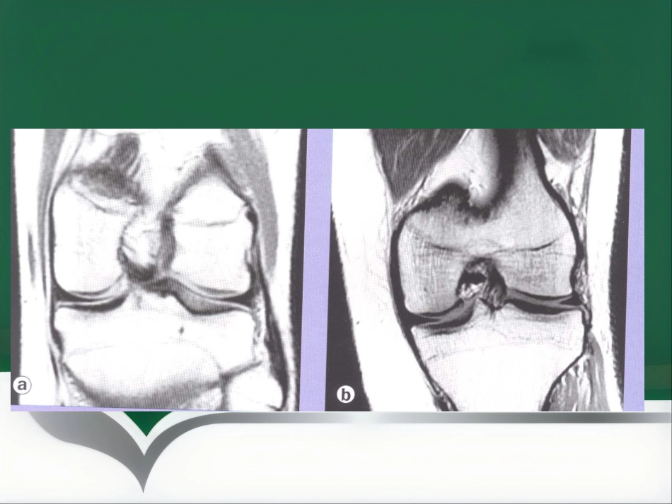 常见骨关节疾病MRI影像学表现_第7页