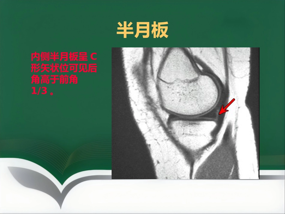 常见骨关节疾病MRI影像学表现_第9页