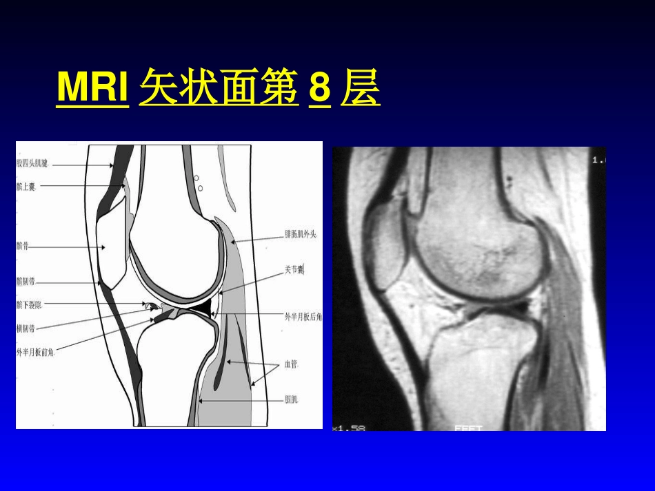 外影像与诊断学：膝关节MRI_第12页