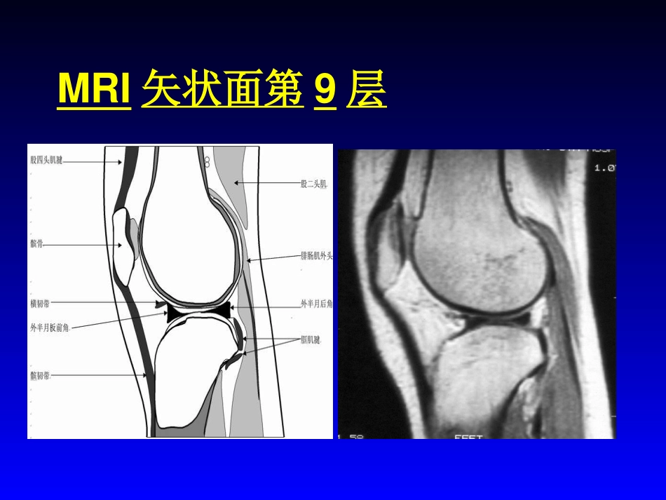 外影像与诊断学：膝关节MRI_第13页