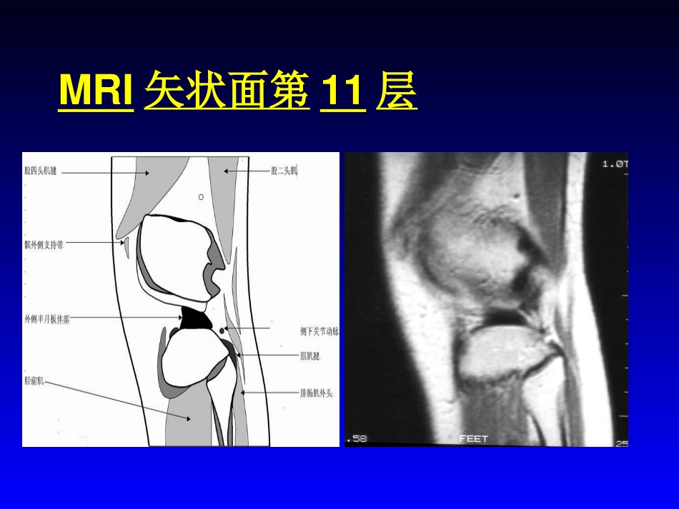 外影像与诊断学：膝关节MRI_第15页