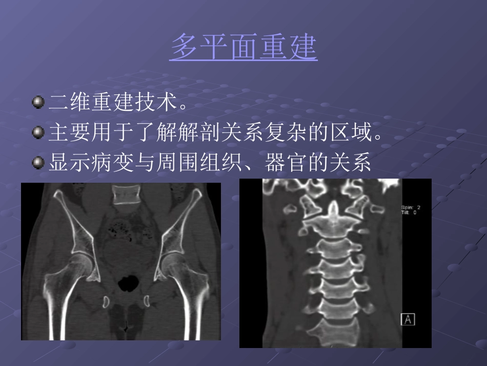 常见脊柱疾病影像学_第8页