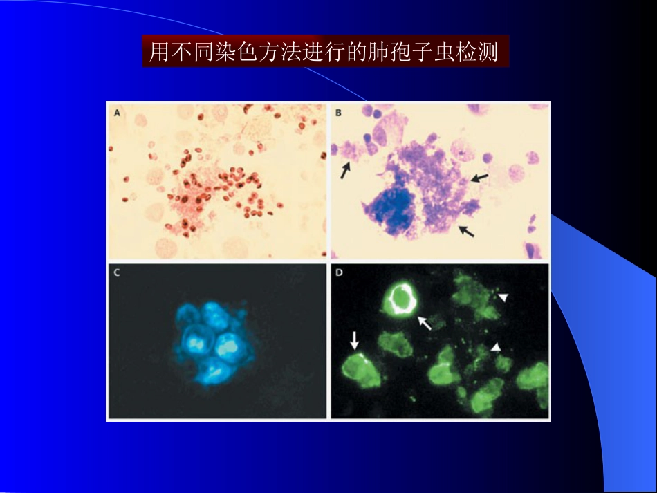 艾滋病临床影像诊断_第8页