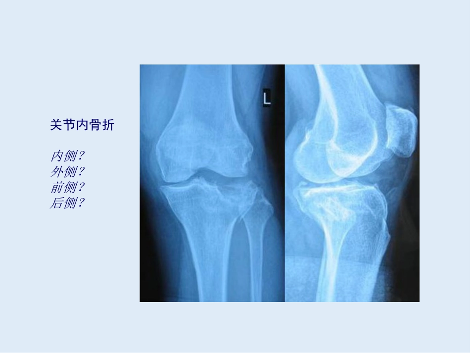 外影像与诊断学：创伤骨科X线片阅片技巧及易漏诊病例讨论_第12页