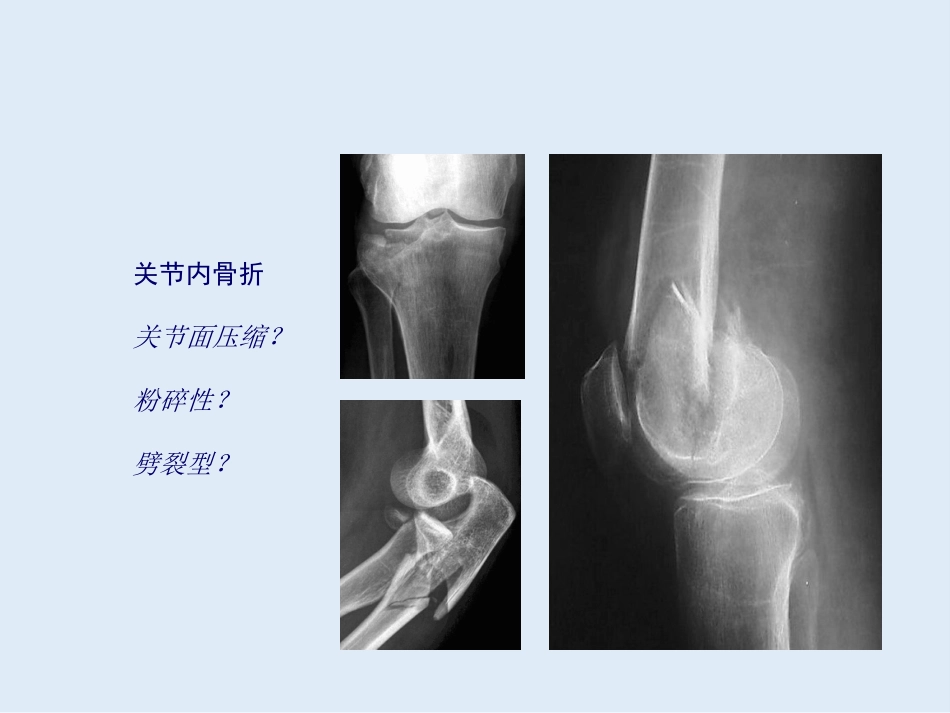 外影像与诊断学：创伤骨科X线片阅片技巧及易漏诊病例讨论_第13页