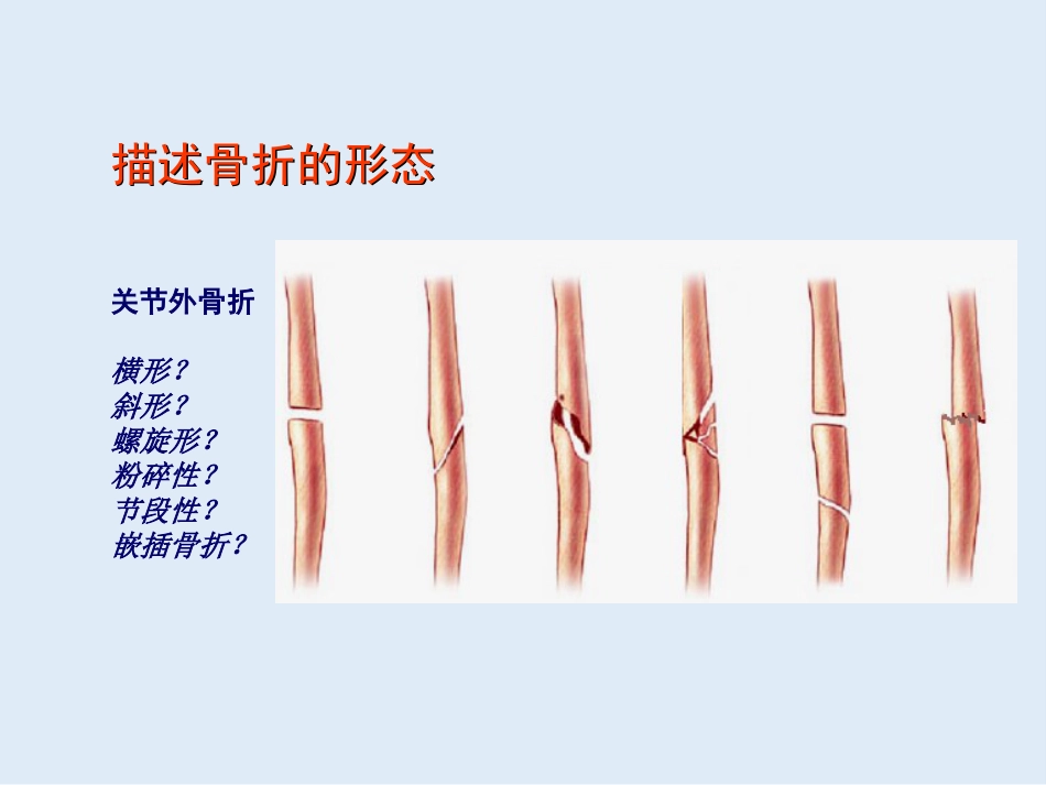 外影像与诊断学：创伤骨科X线片阅片技巧及易漏诊病例讨论_第14页