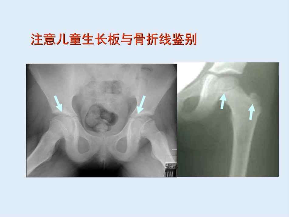 外影像与诊断学：创伤骨科X线片阅片技巧及易漏诊病例讨论_第15页