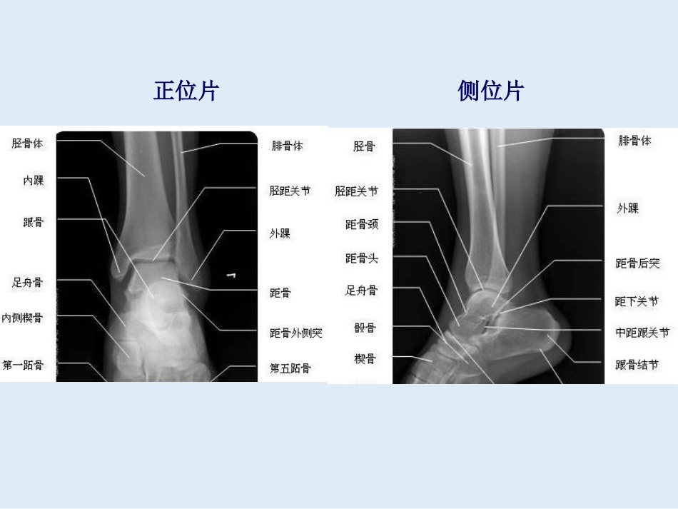 外影像与诊断学：创伤骨科X线片阅片技巧及易漏诊病例讨论_第5页