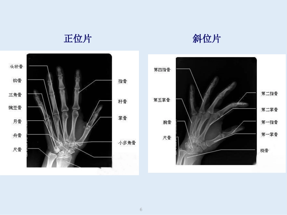 外影像与诊断学：创伤骨科X线片阅片技巧及易漏诊病例讨论_第6页