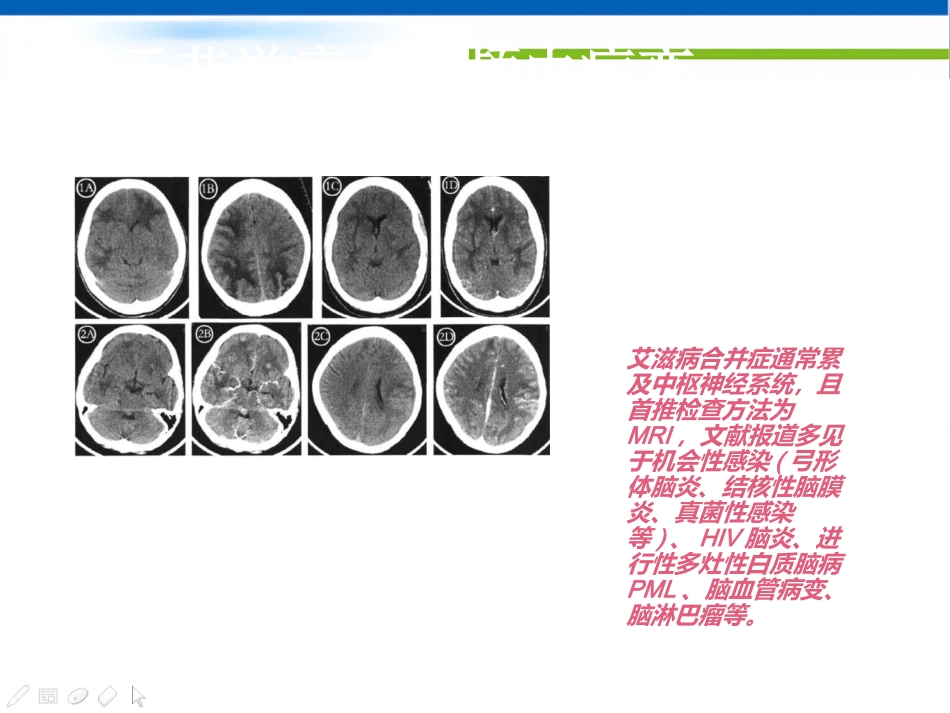 艾滋病的影像学诊断_第6页