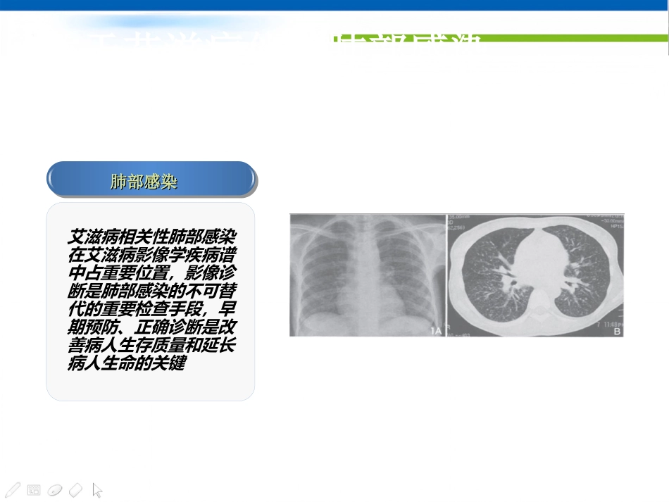 艾滋病的影像学诊断_第7页