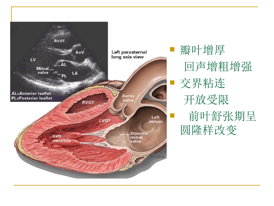 心脏瓣膜病超声诊断_第11页