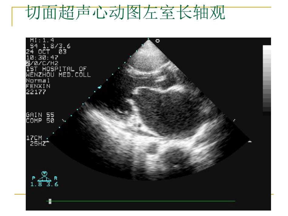 心脏瓣膜病超声诊断_第12页