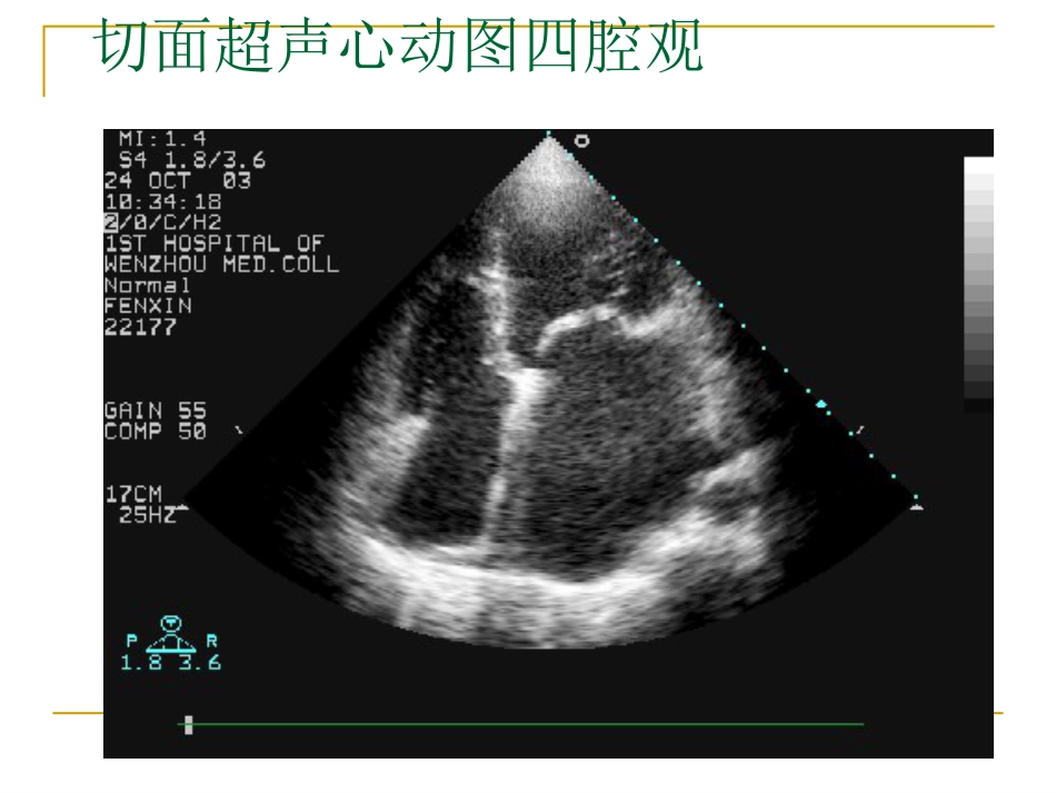 心脏瓣膜病超声诊断_第13页