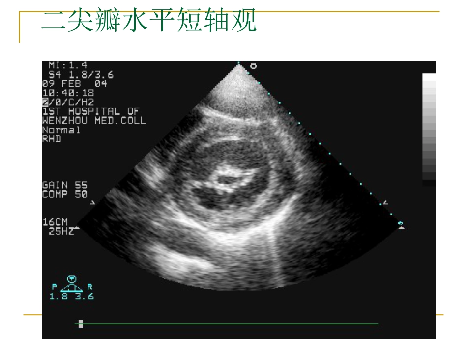 心脏瓣膜病超声诊断_第14页