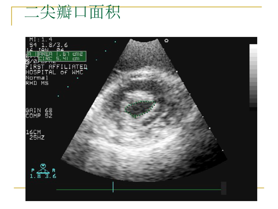 心脏瓣膜病超声诊断_第15页