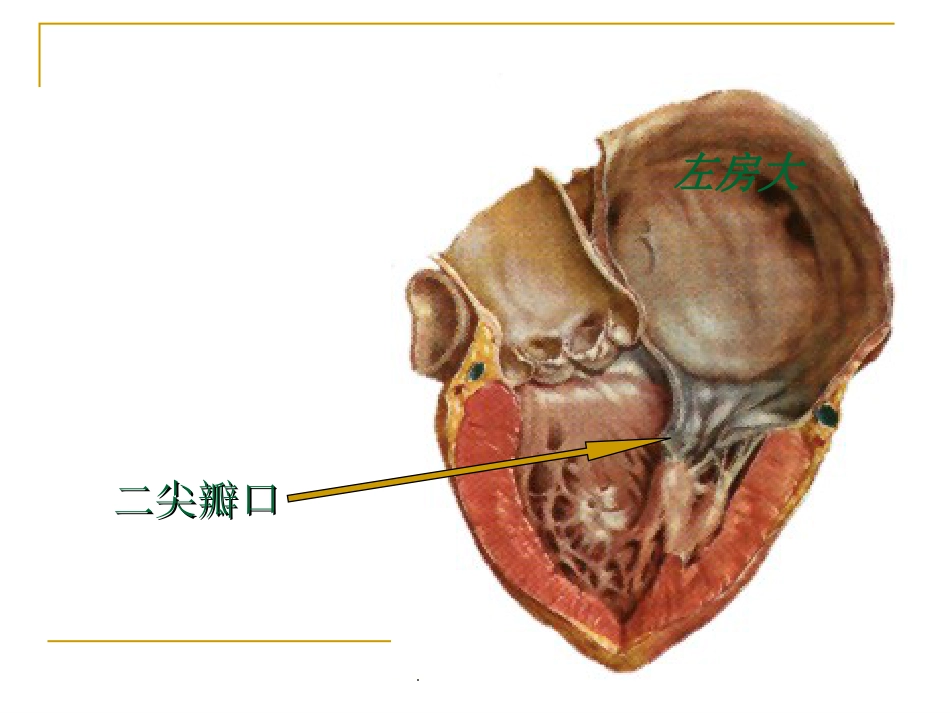 心脏瓣膜病超声诊断_第5页