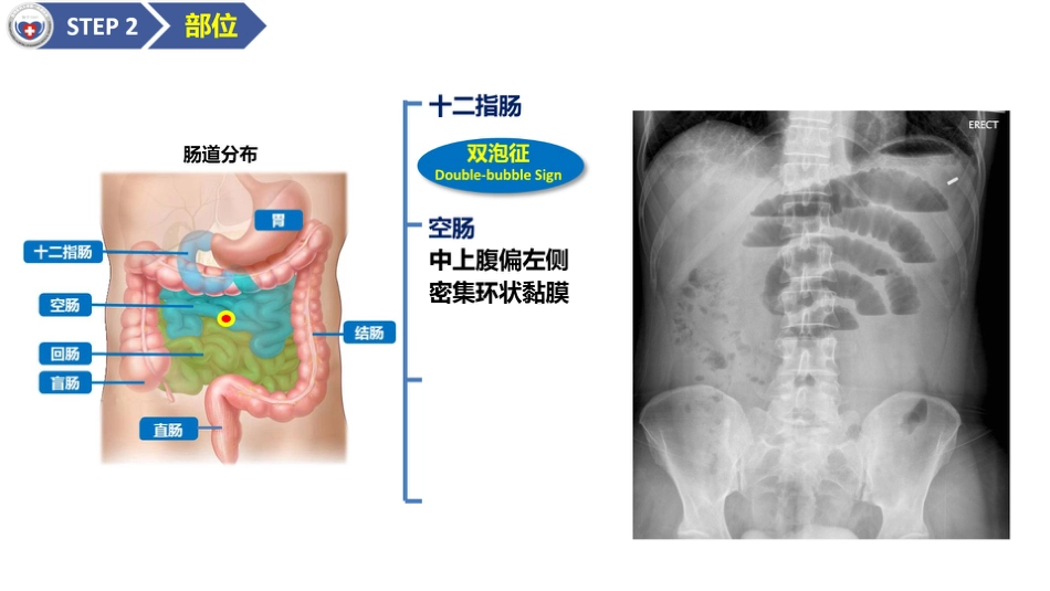 肠梗阻医学影像PPT_第10页