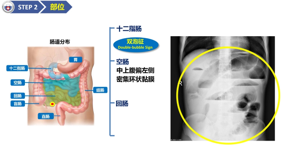 肠梗阻医学影像PPT_第11页